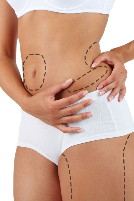 Fettabsaugung (Liposuktion)