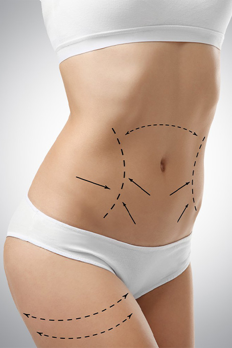 Bauchdeckenstraffung (Abdominoplastik)